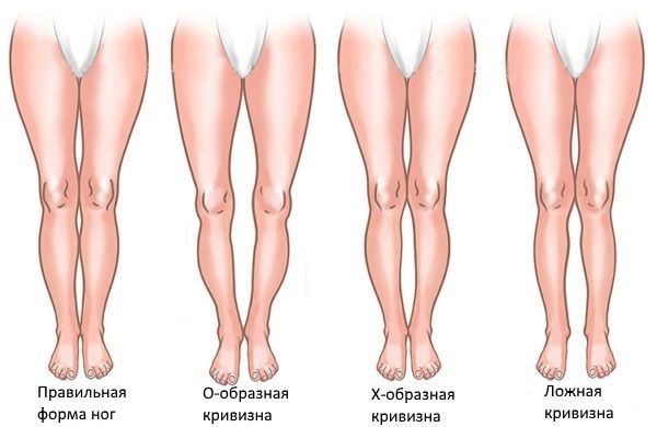 Норма и&nbsp;кривизна ног в&nbsp;области голени