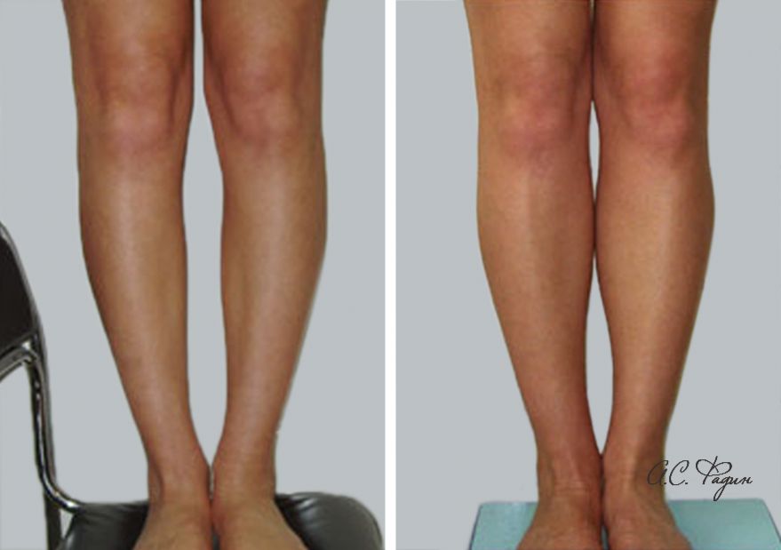 Результат круропластики через 2 месяца после операции