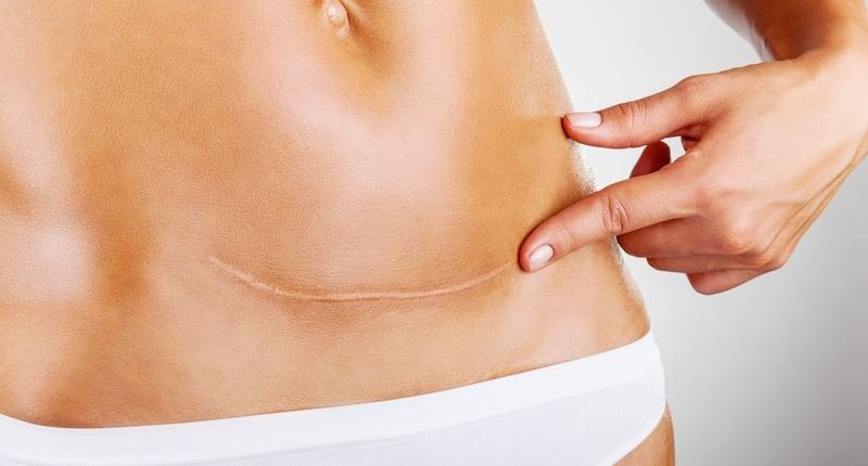 Почему могут расходиться швы после пластики