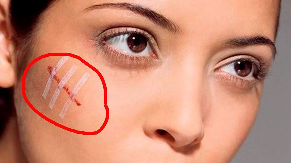 Как правильно поступить если разошелся шов после пластики