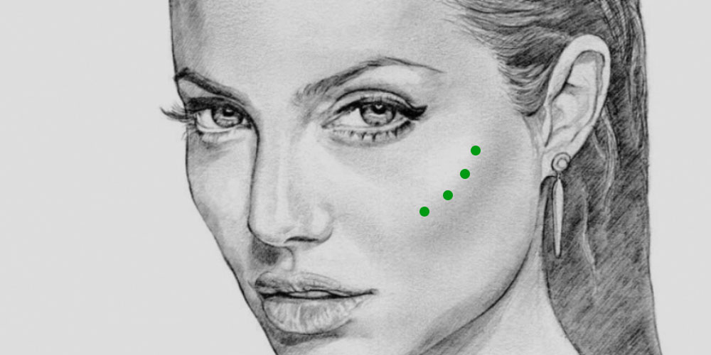 Использование имплантов в скулы