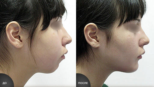 Результат ментопластики в&nbsp;случае недостаточного развития подбородочной ткани