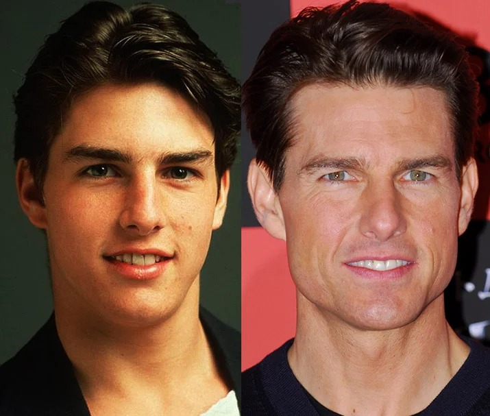 Мужская ментопластика