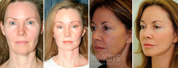Фото до&nbsp;и&nbsp;после омоложения стволовыми клетками