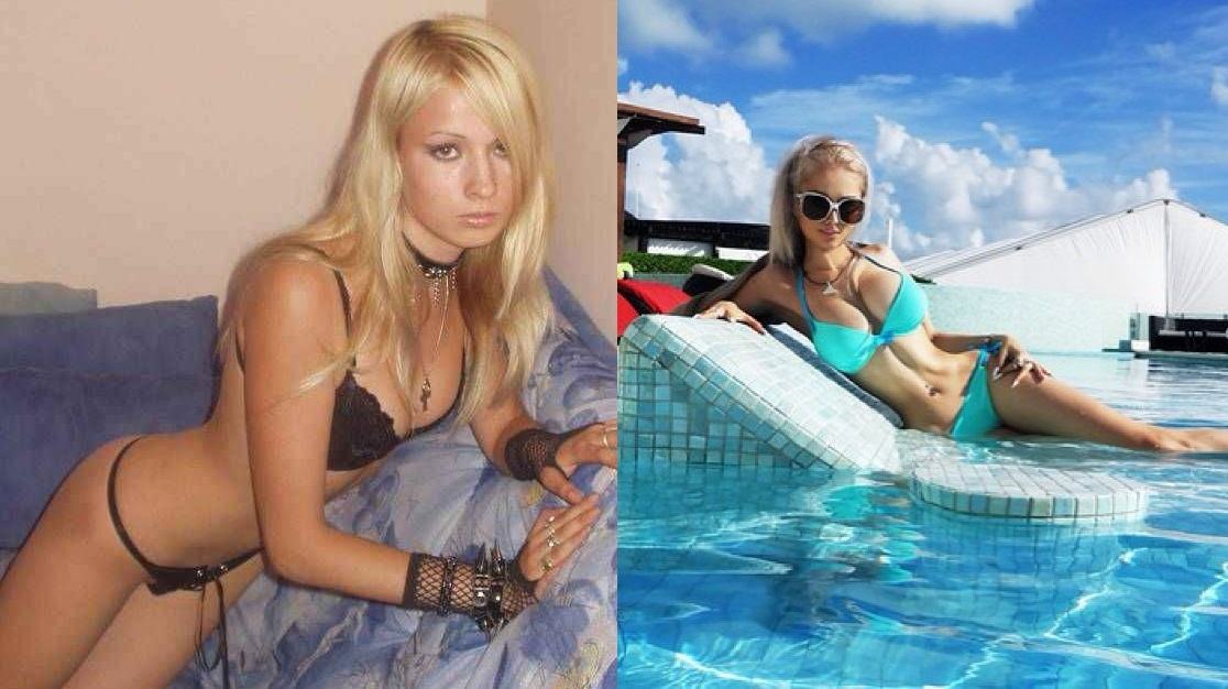 Валерия Лукьянова сделала маммопластику (увеличение груди)