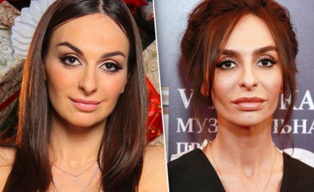 Екатерина Варнава до&nbsp;и&nbsp;после пластических операций