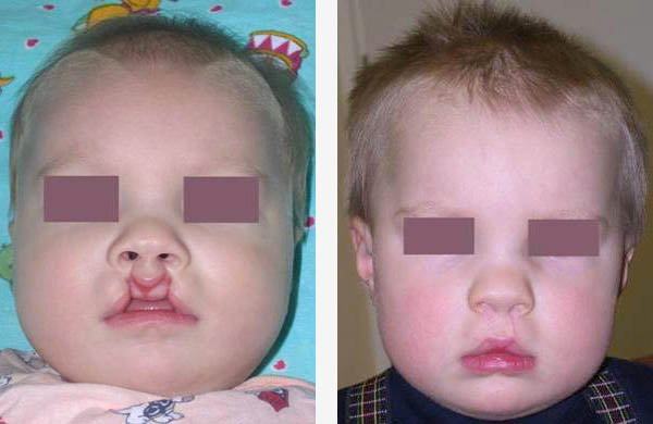 Фото до и после операции по удалению заячьей губы