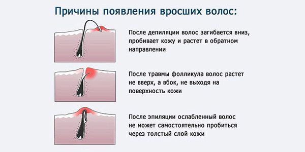 Причины врастания волос