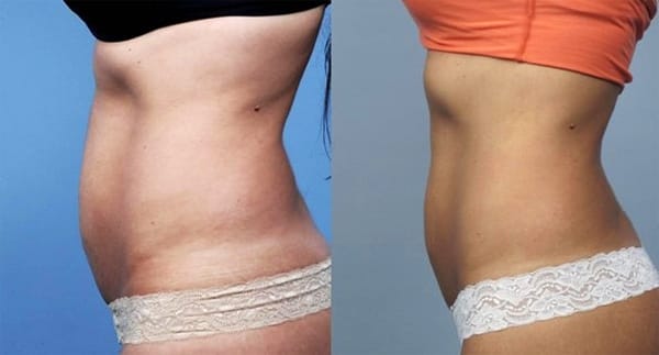 Эффект кавитации на&nbsp;животе и&nbsp;талии