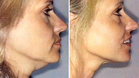 Борьба с&nbsp;вторым подбородком курсом кавитации