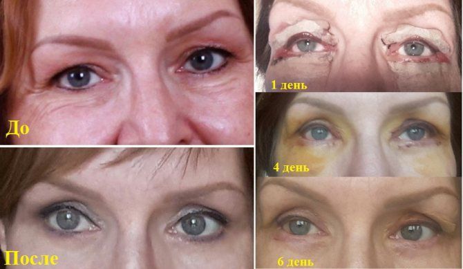 Блефаропластика: до&nbsp;после и&nbsp;во время восстановления