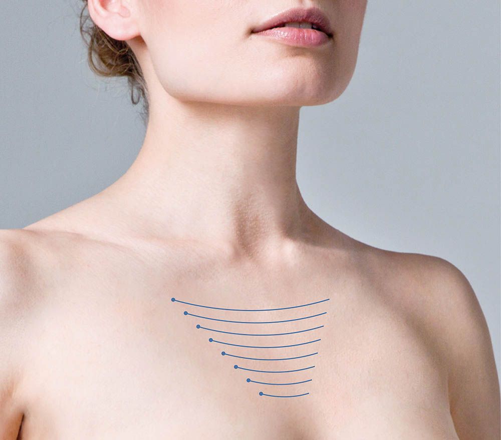 Зона декольте 35 лет