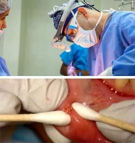 Удаление геля из губ