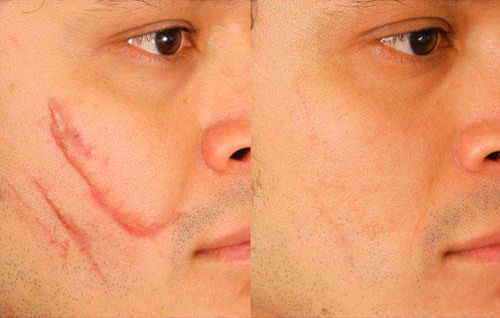 После курса применения крема на свежих рубцах