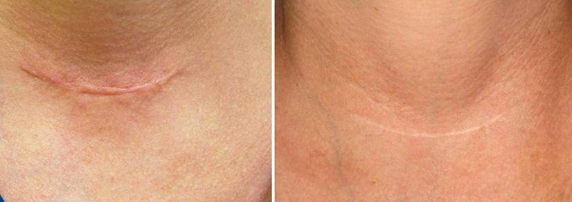 Эффект применения Дерматикса на послеоперационном шраме