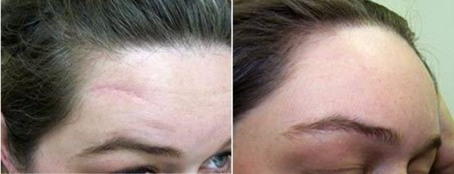 Удаление шрама с выравниваем рельефа