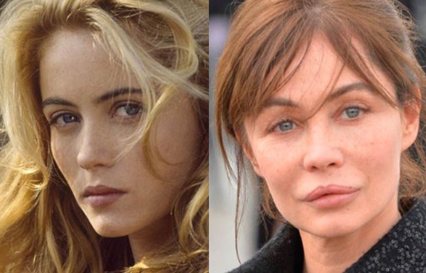 Эммануэль Беар до&nbsp;и&nbsp;после пластики