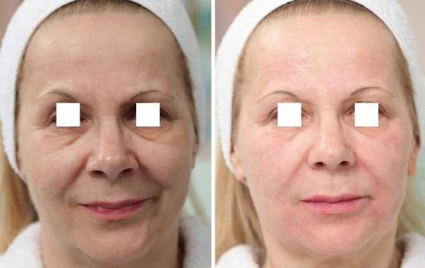 Эффект от&nbsp;NCTF 135