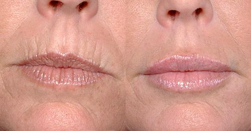 ботокс от морщин вокруг губ