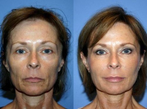 Эффект от применения мезонитей