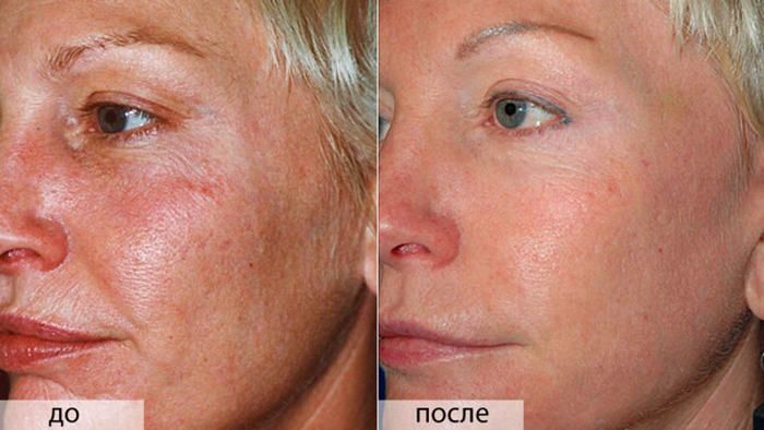 Фото до&nbsp;и&nbsp;после глубокого пилинга