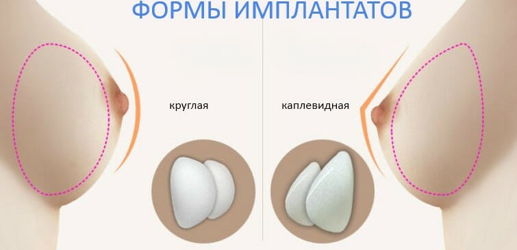 Как выбрать импланты