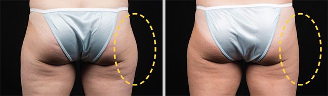 Борьба с проблемными зонами на бедрах