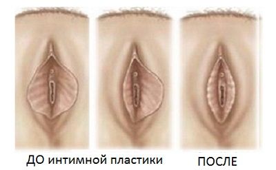 Эффект интимной пластики половых губ