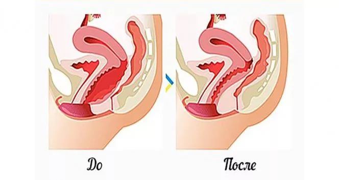Контурная пластика интимной зоны