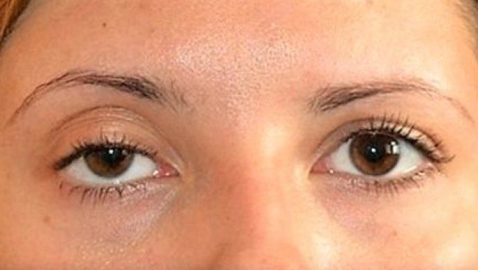 Асимметрия глаз