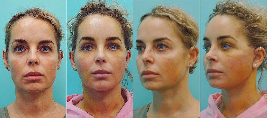 Калманович пластика лица