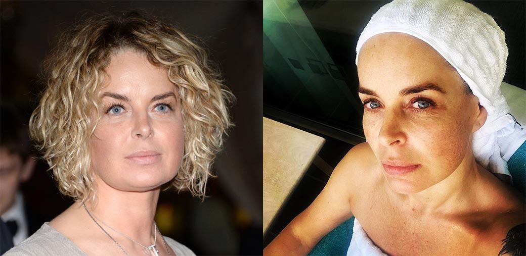 Калманович пластика