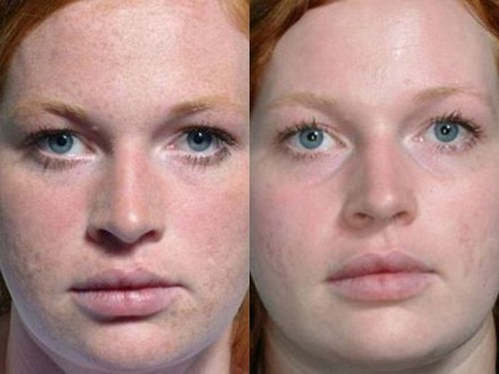 Фото до и после карбонового пилинга