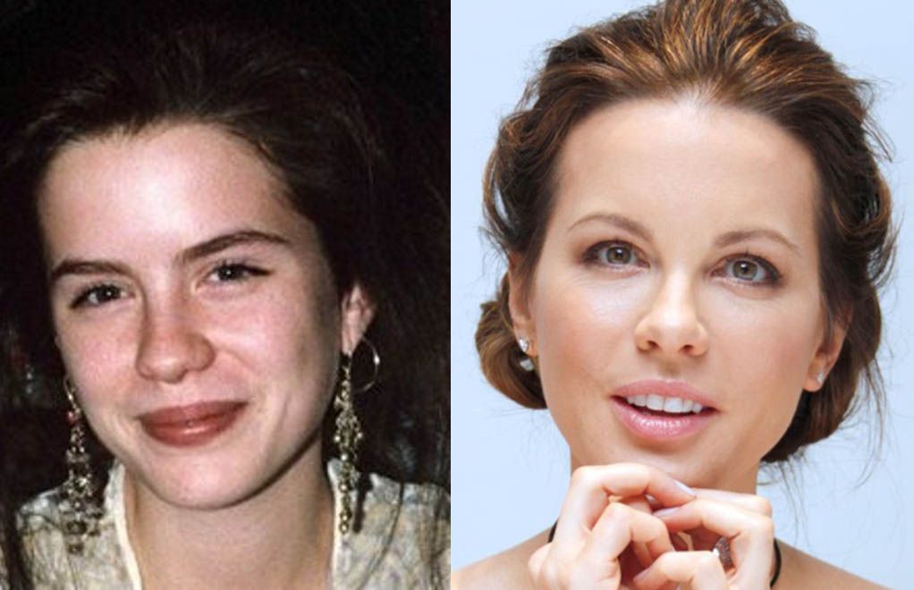 Кейт Бекинсейл ринопластика