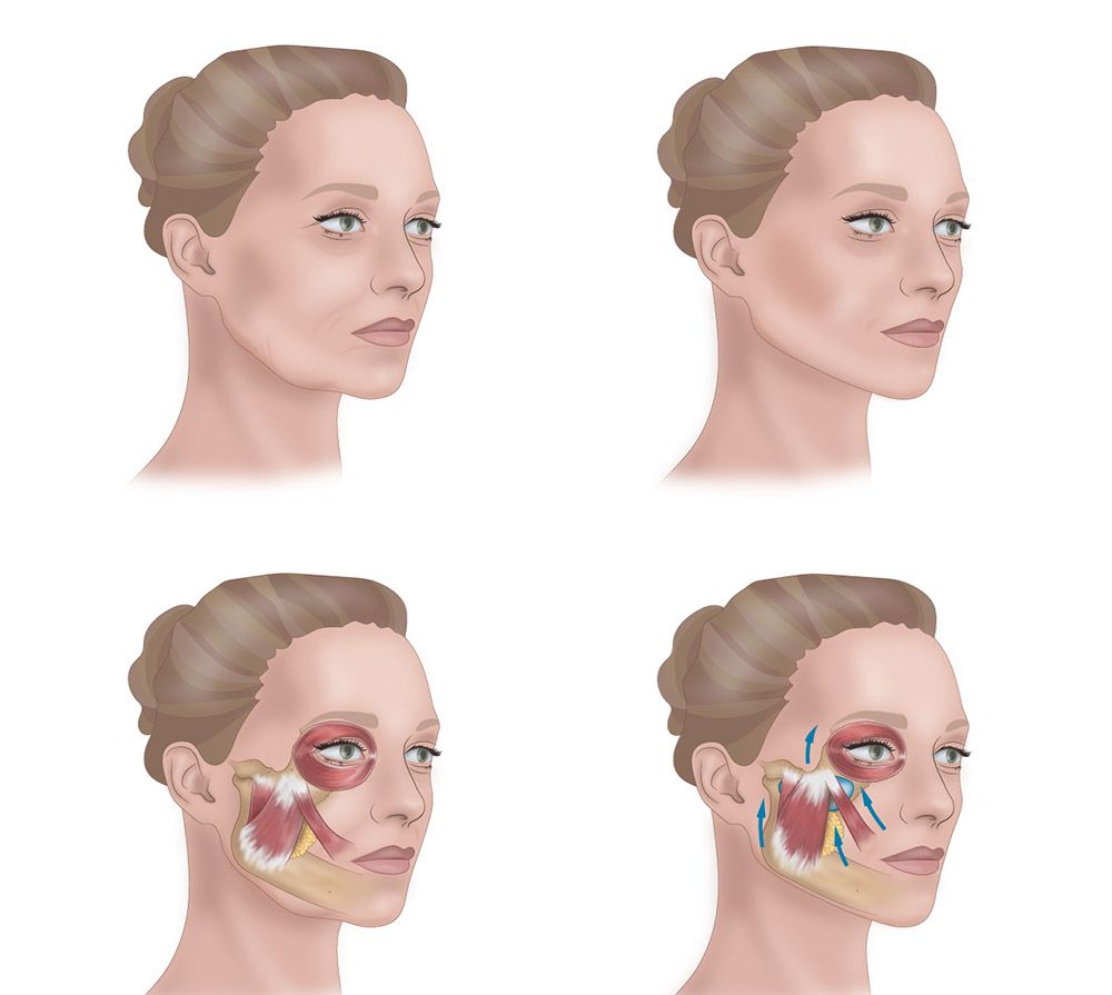 Общая схема коррекции скул филлерами