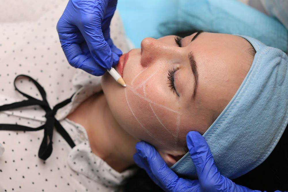 Разметка лица при коррекции скул филлерами