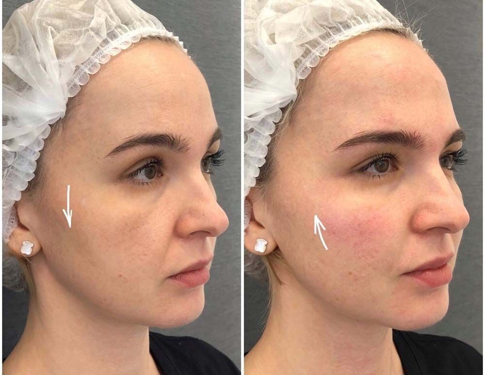 Результат применения филлеров