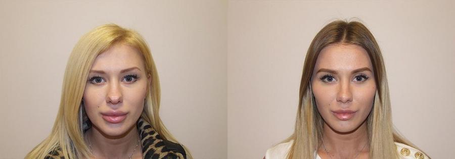 Ковалева до&nbsp;и&nbsp;после пластики