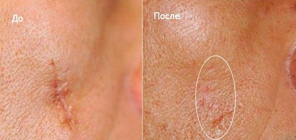 Крем Келофибразе для устранение следов на коже лица