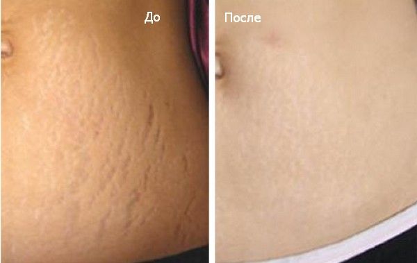 Устранение шрама с применением крема Келофибразе