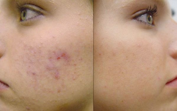 Эффект Келофибразе для устранения растяжек