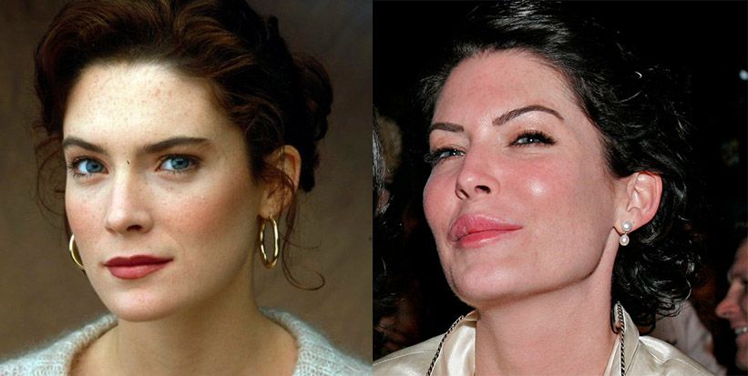 Лара Флинн Бойл ботокс