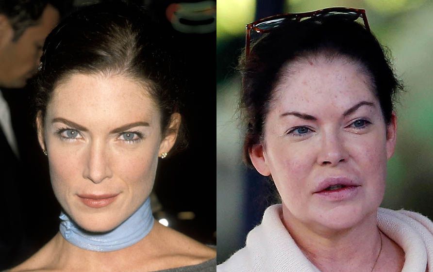 Лара Флинн Бойл пластика век