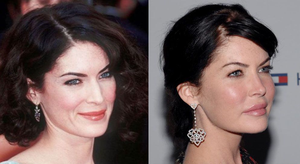 Лара Флинн Бойл ринопластика