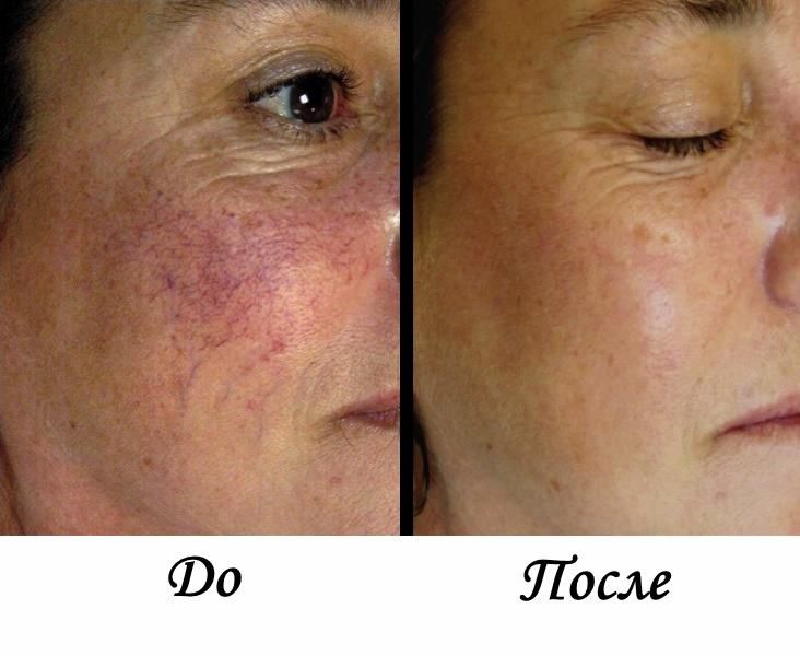 До и после лазеротерапии
