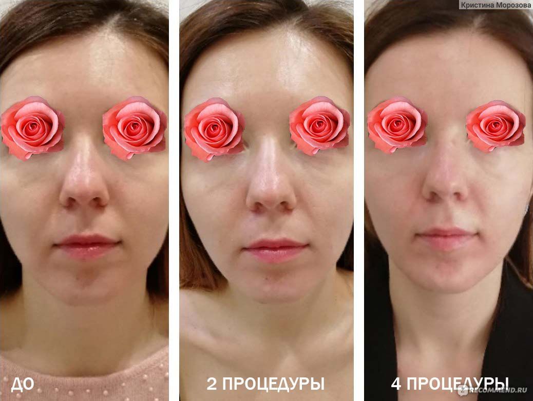 Эффект липолитиков