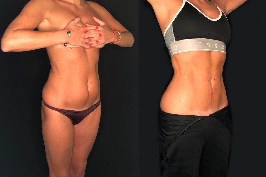 Липоскульптурирование живота