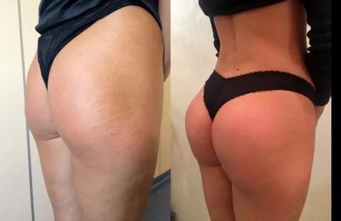 Моделирование ягодиц за&nbsp;счет собственных жировых клеток