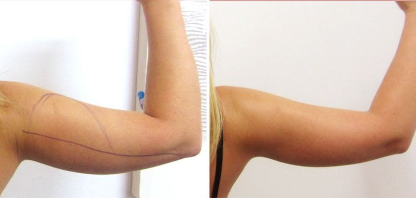 Липомоделирование рук