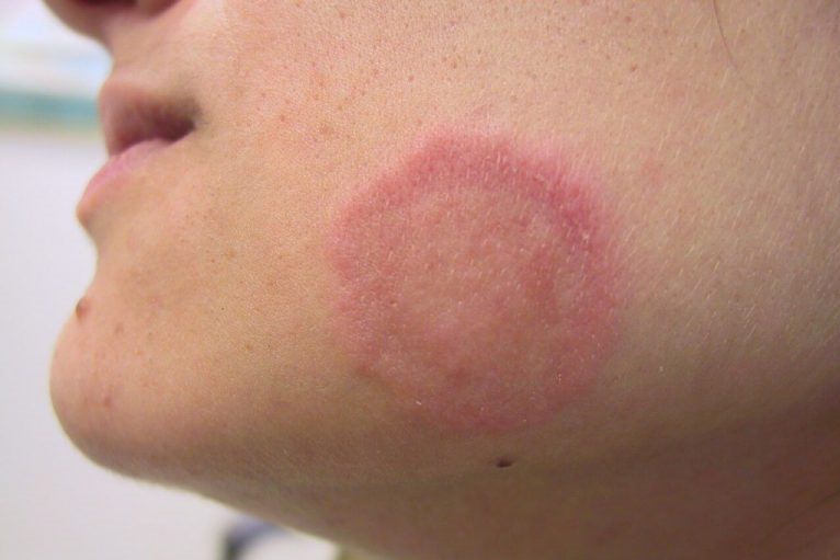 Простой лишай